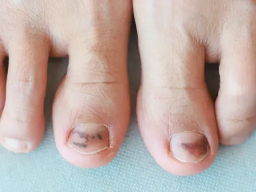 Gros plan sur des orteils, dont deux présentent une plaque de l'ongle abîmée avec des ecchymoses sombres, suggérant un traumatisme.