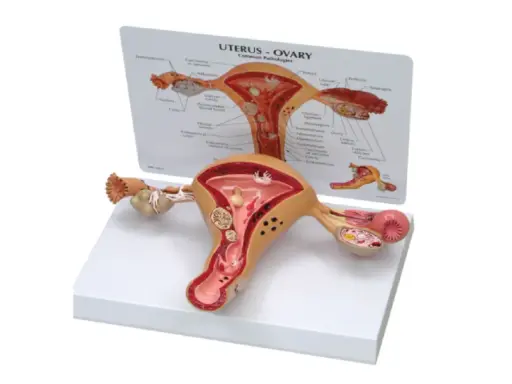 Model anatomiczny narządu rodnego kobiety z widoczną torbielą na jajniku.