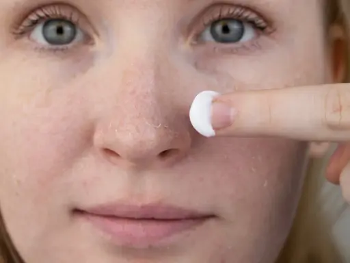 Une personne applique une crème sur son visage, montrant des zones de peau sèche et squameuse, typiques du psoriasis du visage.