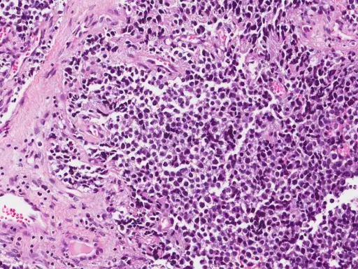 Microscopia di rabdomiosarcoma alveolare: cellule tumorali con nuclei scuri e citoplasma scarso, disposte in nidi separati da tessuto connettivo.