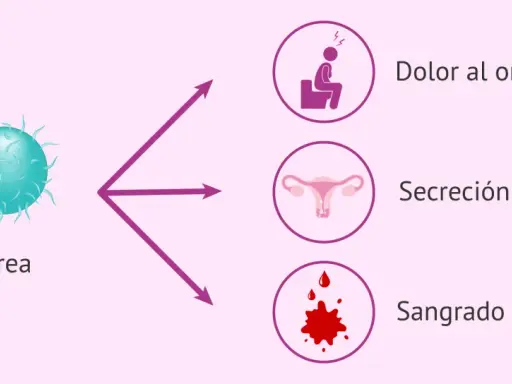 La gonorrea puede causar dolor al orinar, secreción anormal y sangrado vaginal.