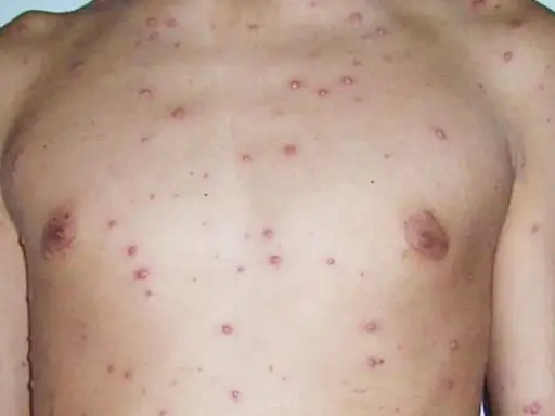 Torso y brazo de persona con granitos varicela leve, pequeños y rojizos, indicando una erupción cutánea.