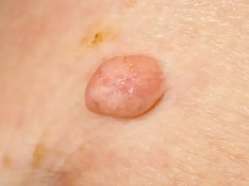 Zmiana skórna, która może być jednym z objawów wirusa HPV. Widoczny różowy, lekko łuszczący się brodawczak.