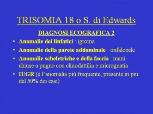 Diagnosi ecografica della trisomia 18: igroma, onfalocele, mani chiuse a pugno, micrognatia e IUGR.