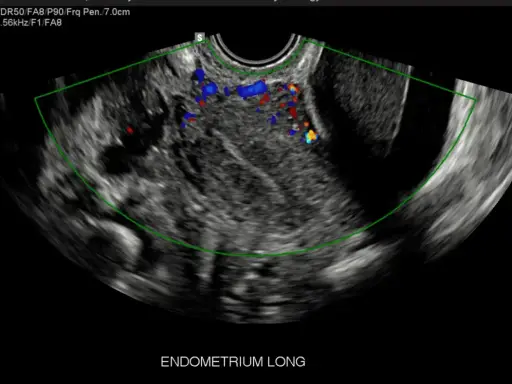 Ecografia pelvica con evidenza di vascolarizzazione anomala, possibile indicatore di tumore ovario.