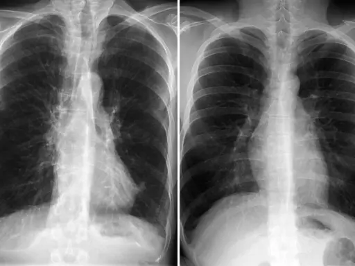 Zwei Röntgenaufnahmen des Brustkorbs zeigen Anzeichen von COPD. Ein rosa Puffer könnte zur Linderung der Symptome beitragen.
