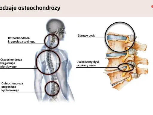 Czy ból jąder może być od kręgosłupa? Ilustracja pokazuje osteochondrozę kręgosłupa szyjnego, piersiowego i lędźwiowego, a także uszkodzony dysk uciskający nerw.