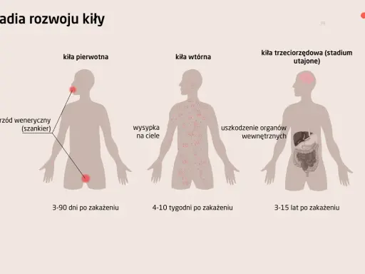 Ilustracja pokazuje stadia rozwoju kiły: pierwotna z wrzodem, wtórna z wysypką skórną, trzeciorzędowa z uszkodzeniem narządów.