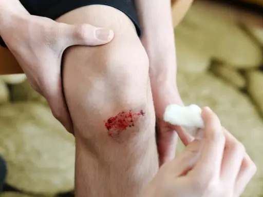 Une main tient un genou avec une **peau lésée** et sanglante, tandis qu'une autre main s'apprête à nettoyer la blessure avec du coton.