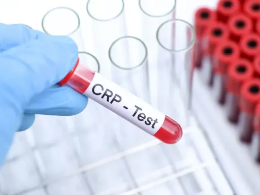 Ręka w niebieskiej rękawiczce trzyma probówkę z napisem "CRP - Test". W tle stoją inne probówki.