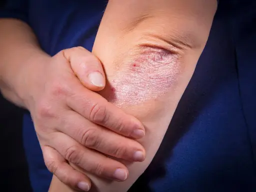 Psoriasis sur le coude, une affection cutanée rouge et squameuse. La main d'une personne touche doucement la zone affectée.