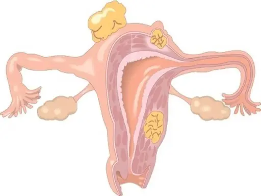 Anatomia kobieca z tyłozgięciem macicy i mięśniakami. Może wpływać na współżycie.