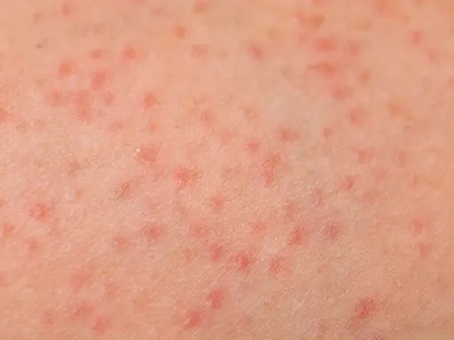 Pelle con prurito alle gambe, caratterizzata da numerosi puntini rossi che indicano un'irritazione cutanea.