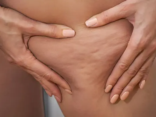 Manos pellizcando piel con celulitis edematosa, mostrando la textura irregular y abultada.