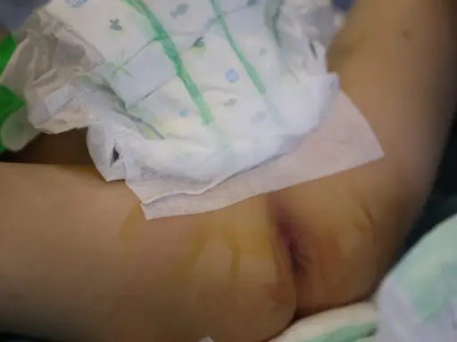 Niemowlę w pieluszce, które 3 latek sika 2 razy dziennie, leży na boku. Widoczne są ślady po wkłuciach.