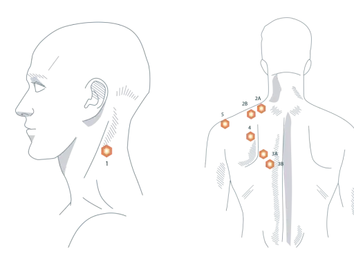 Illustration zeigt Triggerpunkte am Nacken und Rücken, die auf einen verspannten Trapezmuskel und dessen Ursache hinweisen.