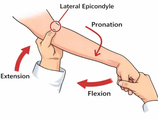 Illustration zeigt einen Tennisarm Test. Der Arzt drückt auf den lateralen Epikondylus, während er Extension und Pronation des Arms ausführt.