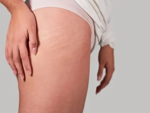 Gros plan sur des vergetures sur les cuisses d'une personne, montrant la texture de la peau.