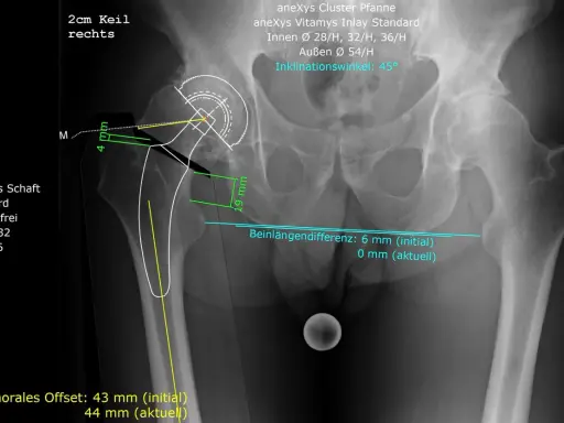 Röntgenbild des rechten Hüftgelenks mit Markierungen zur Beurteilung der coxarthrose stadien und der Beinlänge.