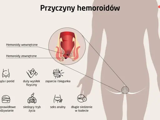 Ilustracja pokazuje przyczyny hemoroidów, w tym ciążę, wysiłek fizyczny, zaparcia, nieprawidłowe odżywianie, siedzący tryb życia i seks analny. Czy hemoroidy są groźne?