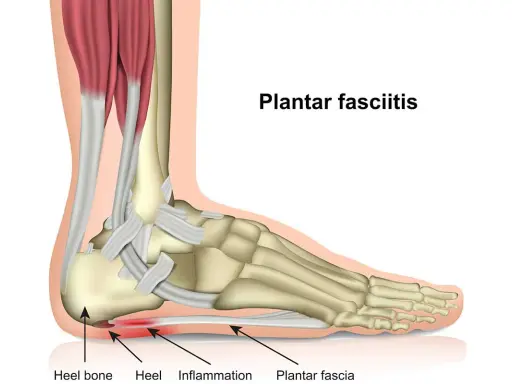 Anatomische Darstellung des Fußes, die zeigt, wie die Plantarfasziitis immer schlimmer wird, mit Entzündung an der Ferse.