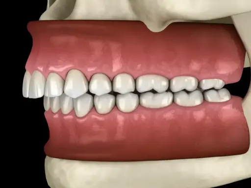 Model szczęki z cofniętą żuchwą u dorosłych. Ilustracja pokazuje problem zgryzowy, który może wymagać leczenia.