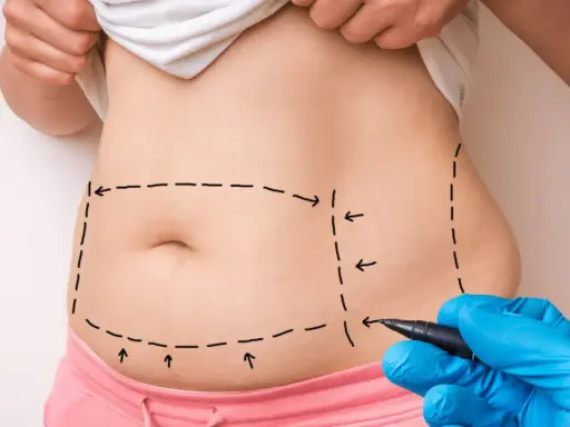 Liposukcja: Odkryj prawdę o odsysaniu tłuszczu. Co musisz wiedzieć?
