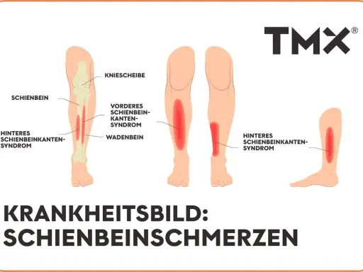 Illustrationen zeigen verschiedene Ursachen für starke Schmerzen im Schienbein im Ruhezustand, wie das vordere und hintere Schienbeinkantensyndrom.