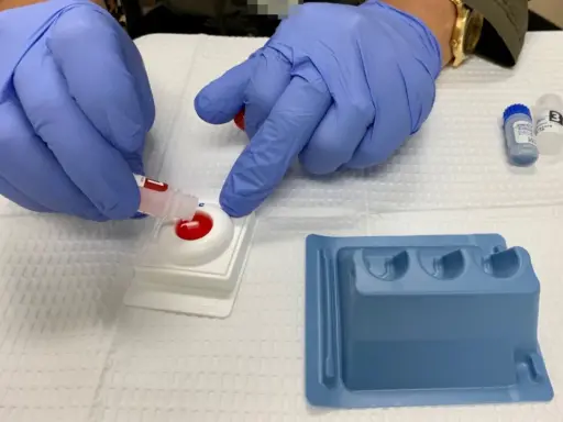 Manos enguantadas realizan prueba rápida para diagnóstico y tratamiento de gonorrea.