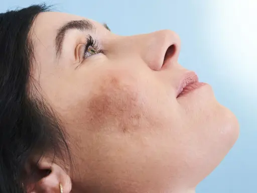 Primo piano del viso di una donna con macchie cutanee visibili, che mostra come coprire le macchie sul viso per un incarnato uniforme.