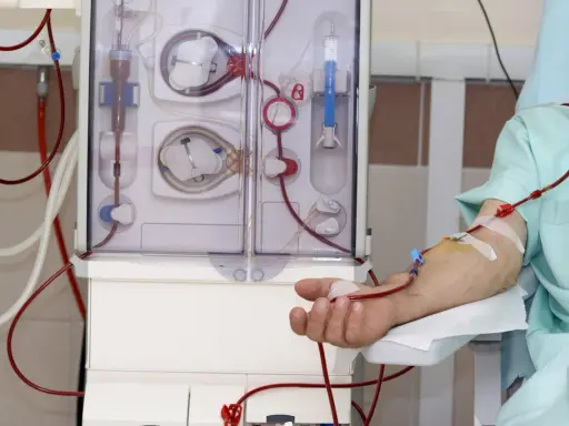 Pacjent podłączony do aparatu do dializy. Czerwone przewody doprowadzają krew do maszyny, która oczyszcza ją. To właśnie dializa co to jest w praktyce.