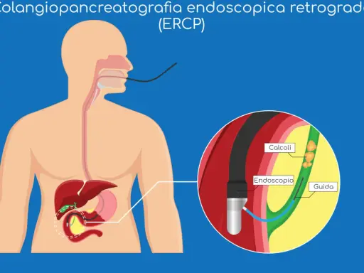 ERCP: endoscopio inserito per rimuovere calcoli che causano ostruzione coledoco.