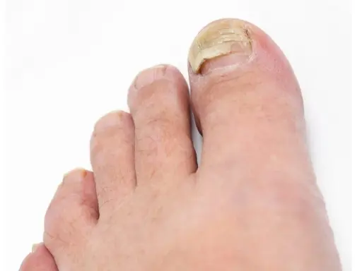 Gros plan sur un ongle d'orteil atteint d'un décollement ongle choc, jauni et épaissi.
