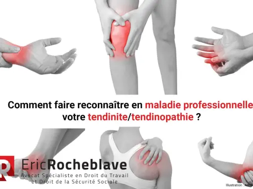 Douleurs articulaires (poignet, genou, doigt, épaule, coude) : comment faire reconnaître votre tendinite en maladie professionnelle.
