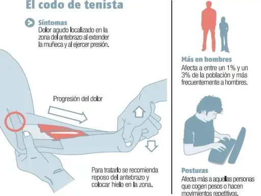 Codo de tenista: Síntomas clave, causas y alivio efectivo ¿Lo sufres?