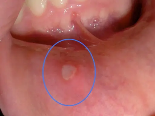 Una piccola bolla in bocca a un bambino, evidenziata da un cerchio blu. Potrebbe essere un afta o una piccola lesione.
