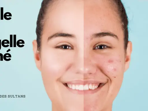 Visage divisé montrant une peau nette et une peau acnéique, avec le texte "Huile de Nigelle Acné".
