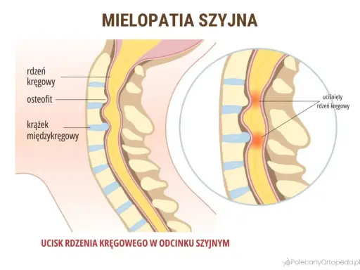 Objawy neurologiczne kręgosłupa szyjnego: kiedy to poważne?