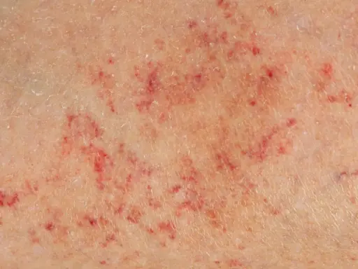 Wybroczyny na skórze, jeden z niepokojących objawów meningokoków. Czerwone plamki i wybroczyny mogą świadczyć o groźnej infekcji.