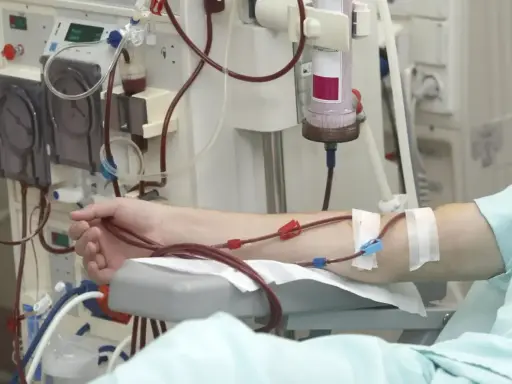 Ramię pacjenta podłączone do aparatury do dializy. Rozważamy dializa otrzewnowa wady i zalety.