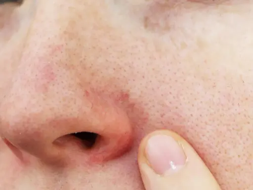 Gros plan sur un nez avec une légère rougeur autour des narines et des pores visibles. Un doigt effleure la peau.