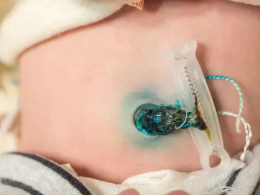 Piccolo granuloma ombelicale con clip e cordone residuo su pelle neonatale.