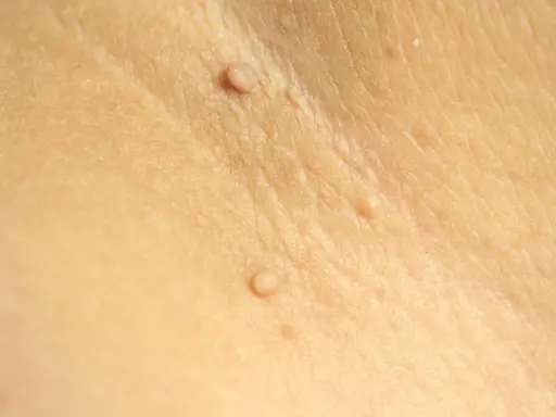 Gros plan sur une peau claire montrant plusieurs petites excroissances cutanées, certaines ressemblant à des grains de beauté ou des verrues.
