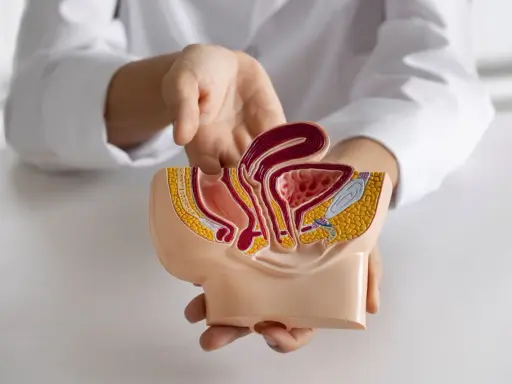 Model anatomiczny przedstawia narządy miednicy mniejszej, gdzie widoczny jest polip cewki moczowej.
