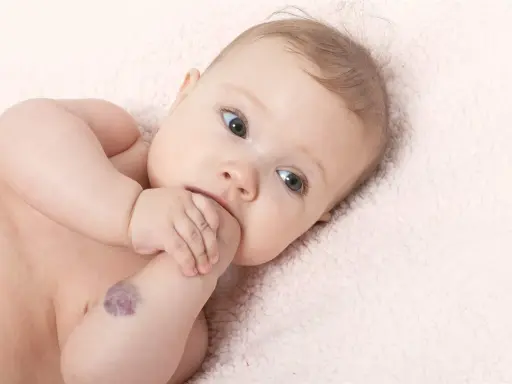 Bebé con un angioma en el brazo, mirando a la cámara con curiosidad.
