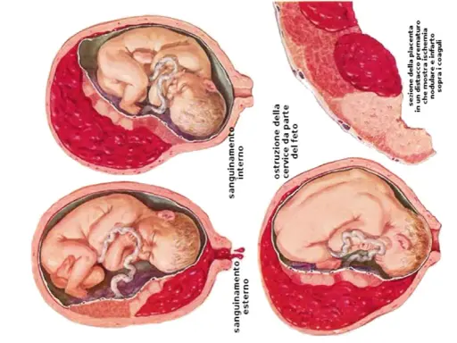 Illustrazioni mediche mostrano complicazioni della gravidanza: sanguinamento interno/esterno, ostruzione cervicale e distacco prematuro della placenta, evidenziando la placenta bassa.