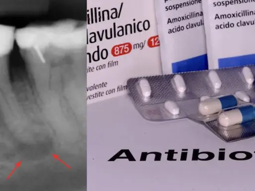Radiografia dentale con segni di infezione e confezioni di amoxicillina/acido clavulanico, un antibiotico e antinfiammatorio.