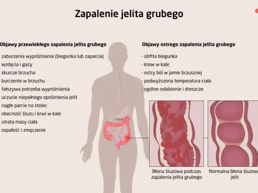 Ilustracja przedstawia objawy zapalenia jelita grubego, takie jak biegunka, ból brzucha, krew w kale, gorączka i zmęczenie.