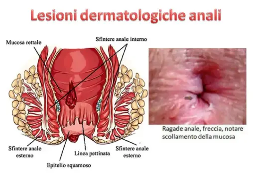 Illustrazione anatomica dell'ano e immagine ravvicinata di una ragade anale con freccia che indica lo scollamento della mucosa. Si notano puntini bianchi nell'area anale.