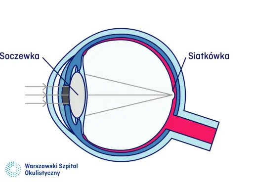 Schemat oka ilustrujący zaburzenia refrakcji i akomodacji. Światło przechodzi przez soczewkę i skupia się na siatkówce.